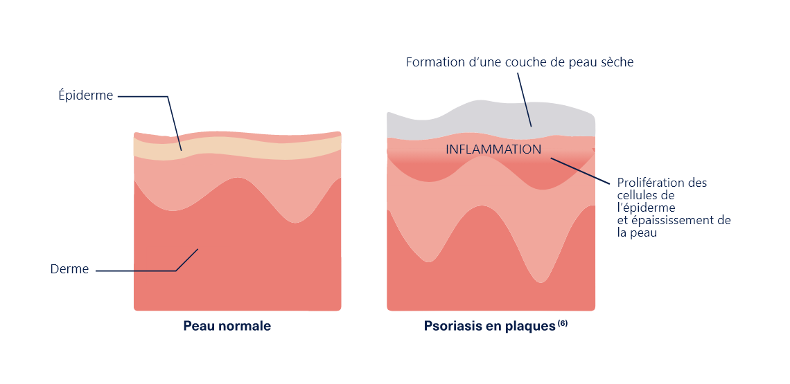 Le mécanisme du psoriasis en plaques